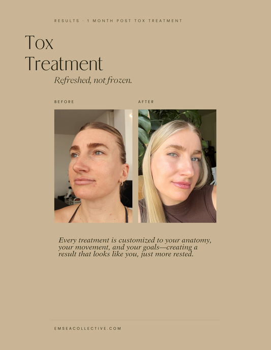 Thinking About Botox?!